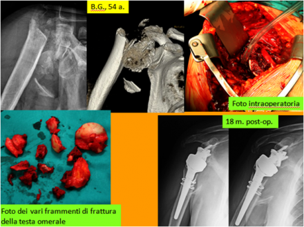 LA PROTESI DI SPALLA NELLE GRAVI FRATTURE DELLA TESTA OMERALE - ORTOPEDIA E TRAUMATOLOGIA
