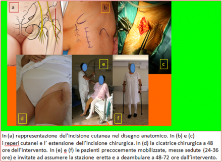 ARTROPROTESI  D'ANCA CON LA TECNICA MINI-INVASIVA ANTERIORE - ORTOPEDIA E TRAUMATOLOGIA