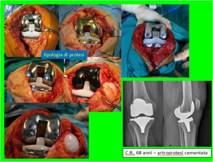 LA PROTESI TOTALE DI GINOCCHIO - ORTOPEDIA E TRAUMATOLOGIA